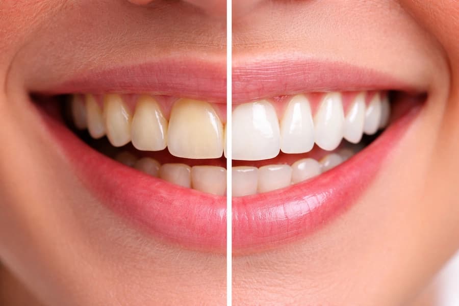 Cosmetic Dentistry smile makeover