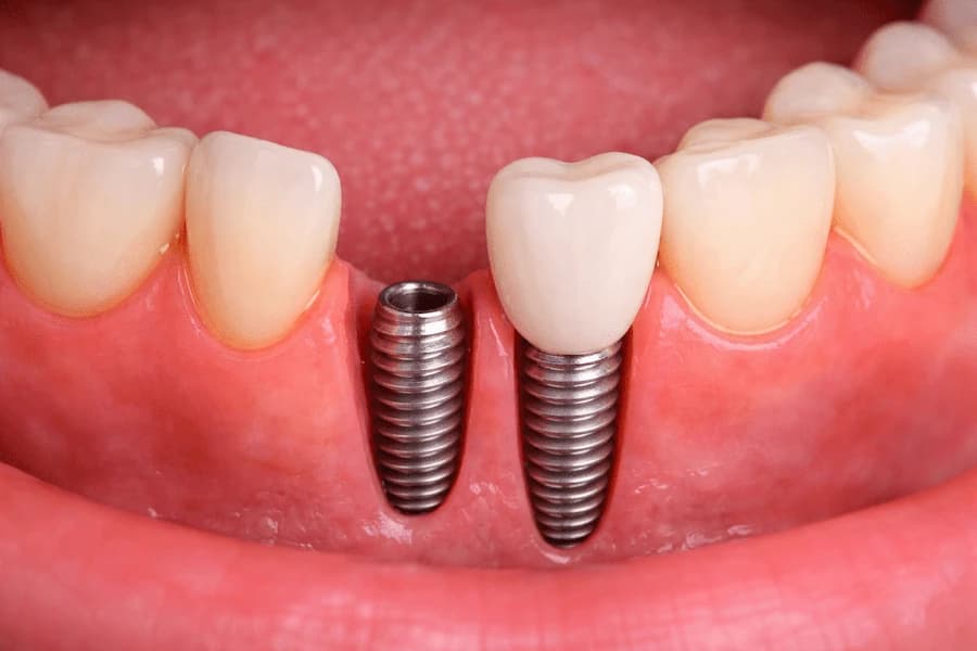 Dental Implants full mouth restoration